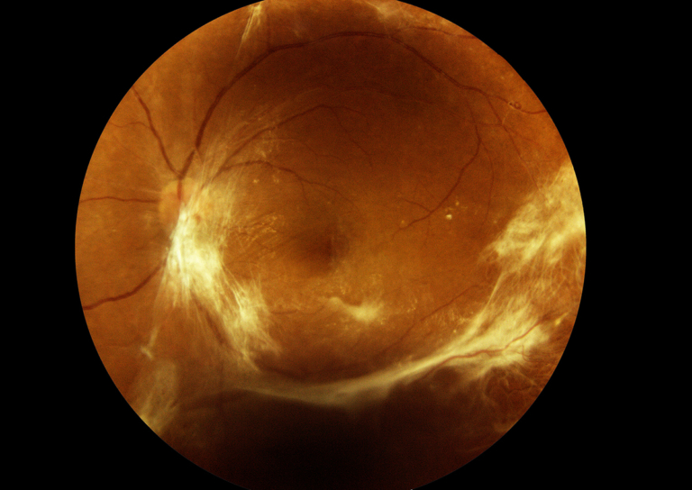 Is Early Diagnosis Important with Diabetic Eye Disease? | Eye